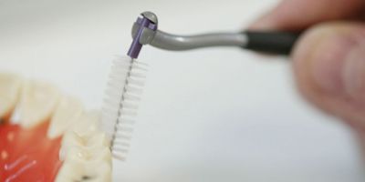 Parodontosebehandlung mit moderner Vector-Therapie