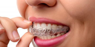 Individuell gefertigte Aufbiss- und Sportschutzschienen